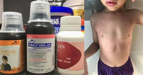 Terbilang tahan lama, telur nyatanya bisa disimpan selama satu tahun dan tetap bisa dikonsumsi. Badan Anak Naik Ruam Lepas Diberi Ubat Demam Yang Disimpan ...