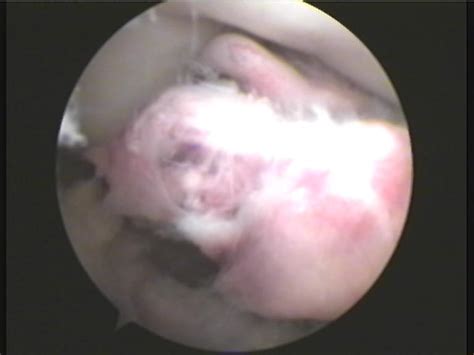 Tibial Spine Avulsion Fractures: Current Concepts and ...
