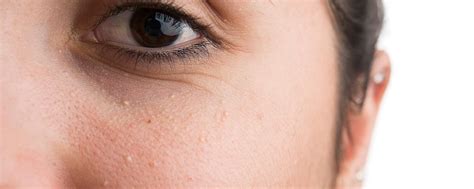 Kelopak mata juga menjaga mata tetap lembab dengan membantu menyebarkan air mata yang dihasilkan oleh saluran air mata. Cara Menghilangkan Bintik Di Bawah Kelopak Mata - Terkait Mata