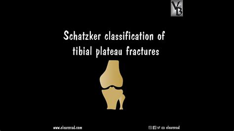 Tibial plateau fractures can be classified through the schatzker classification. Schatzker classification of tibial plateau fractures - YouTube