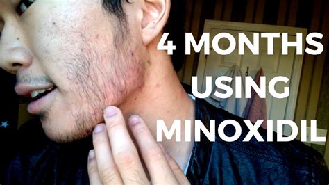 Here are some minoxidil beard before and after results! Minoxidil beard asian before after - BeardStylesHQ