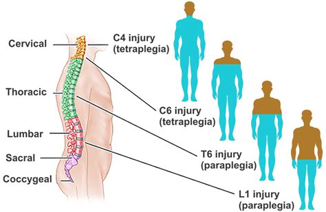 An injury to the spinal cord interrupts messages between the brain and the rest of the body, causing a loss the spinal cord is responsible for communicating two way messages to and from the brain to all areas of the it is mandatory to procure user consent prior to running these cookies on your website. Spinal Cord Injury - Stem Cell Therapy