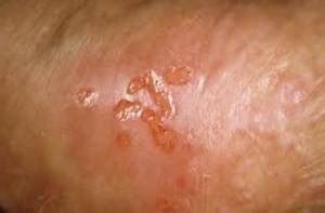 However, when symptoms start manifesting, they can be extremely discomforting. Male Yeast Infection: Symptoms, Causes and Treatments ...