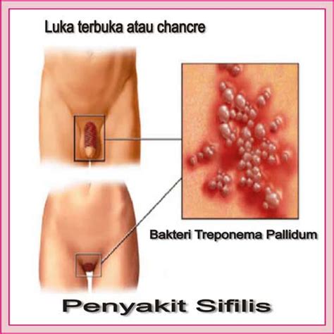 Indra, jakarta, obat sipilis, lewat bca. Lubang Pinggir Penis Pada Pria Lecet | Agen Resmi Obat Herbal