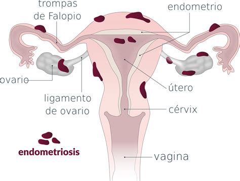 An der linden pj (1996). Endometriosis: diagnóstico y tratamiento de una enfermedad ...