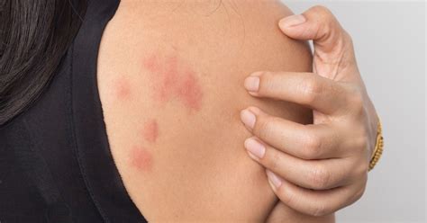 Meaning of hives medical term. Stress Hives: Causes, Treatment, and More