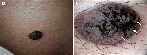 Ingrown hair or genital wart !?! A Pigmented, Hemorrhagic Genital Wart: Clinical ...