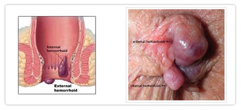 Piles (haemorrhoids) are lumps inside and around your bottom (anus). TREATMENT FOR FISTULA,PILES, THREAD TREATMENT FOR PILES ...