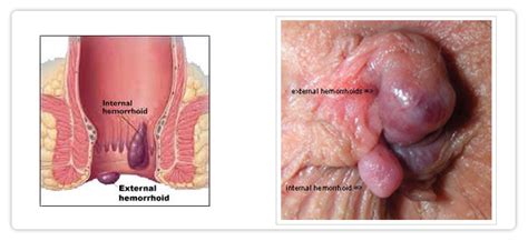 Hemorrhoids (piles) are commonly caused by straining while having a bowel movement, pregnancy, colon symptoms of hemorrhoids include rectal bleeding, rectal pain and itching, and swelling. TREATMENT FOR FISTULA,PILES, THREAD TREATMENT FOR PILES ...