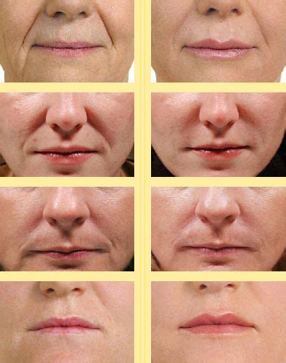 The largest clean beauty skin care assortment formulated with only clean ingredients. How To Get Rid Of Laugh, Smile, And Nasal Lines With ...