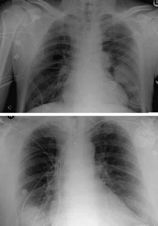 The life expectancy of a dog diagnosed with lung cancer can be up to 22 months, depending on the type of tumor and on the treatment the dog undergoes. Secondary Lung Tumors | Thoracic Key