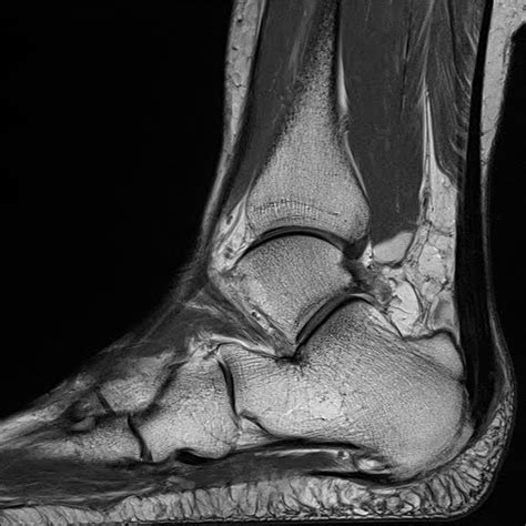 Surgical treatment for haglund's deformity. Radiology Cases: Haglund's Deformity and Syndrome