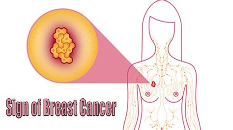 Your bladder and bowels can be a good indicator of uterine problems, and that includes cancer. 6 Warning Signs of Breast Cancer You Should Never Ignore ...