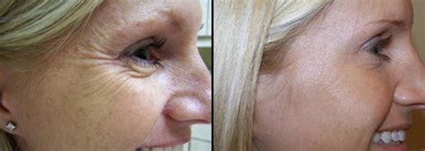 The skin is very thin around suitable dysport and botox doses for crow's feet. Crows Feet - Southern Cosmetic Laser | Charleston Botox ...