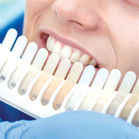 Mismo caso que anterior, un tratamiento en casa y otro combinado. Blanqueamiento dental en casa | Dentista Guadix