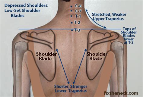 About a month ago, i noticed a significant lump on top of my right shoulder. Overcoming Chronic Neck Pain: Postural Causes and A Unique ...