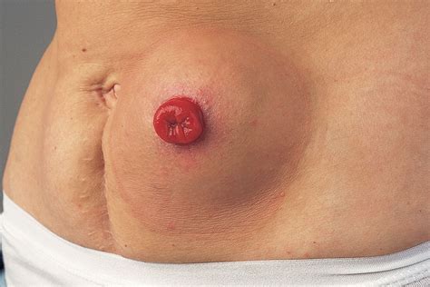 Download in under 30 seconds. What is a hernia and how can it be prevented?