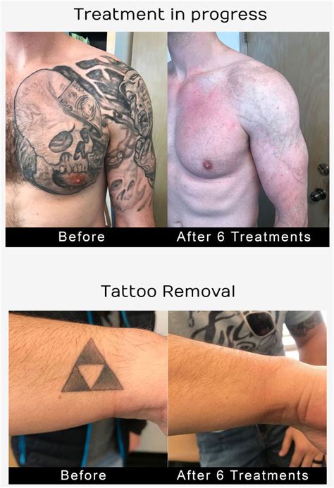 It's possible to begin out a tattoo removal company and key to the booming sector. Tattoo Removal Los Angeles - Laser Tattoo Removers