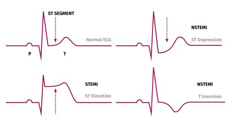 Peaked upright or inverted t wave indicating injury pci may also be indicated in patients with unstable angina and nstemi for patients who are at high risk due to. Rod Cape on Twitter: "#ECG review: #STEMI v #NSTEMI…