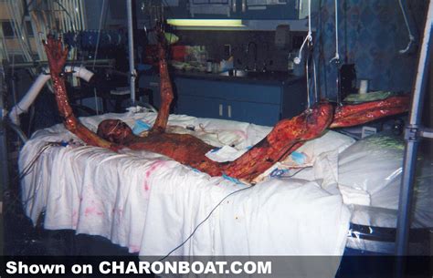 This site contains information about chernobyl radiation victims. CharonBoat.com - Showing Beyond: Medical -> Severe burns