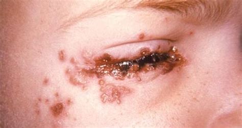 One of the main symptoms is a rash of blisters that doctors sometimes. Viral skin rashes in adults