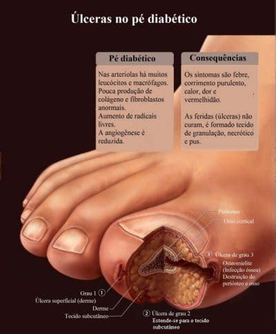 As lesões são pequenas e, normalmente, se localizam no tronco e parte proximal dos braços e coxas. Pele seca nas pernas, conheça as causas e os sintomas