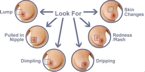 Because of this, men often don't know they have breast cancer until it is advanced. Three signs to tell if a breast lump is normal or abnormal ...