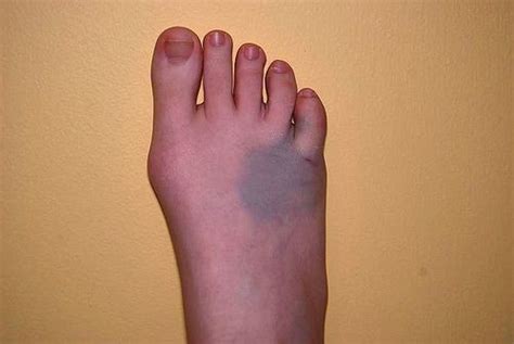 Maybe you would like to learn more about one of these? Broken Pinky Toe | Broken Pinkie Toe | Pinky toe, Broken ...
