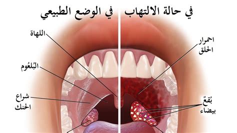 الانكماش في البرد قد يزداد. علاج التهاب الحلق والزكام , العلاج والوقايه من نزلات البرد ...