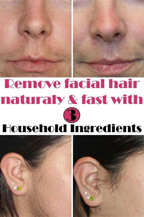 If you plan on using an epilator on other areas, emjoi emagine can take care of both the face and the body using 72 tweezers on dual heads, to get you hairless quickly while minimizing pain. Natural way to remove facial hair | Female facial hair ...