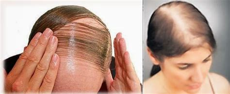 Proses anabolisma ini termasuklah pertumbuhan rambut. Paku Midin: 5 Cara Mudah Lebatkan Rambut