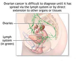 It is important to know the signs and symptoms of ovarian cancer. Endometrial Cancer News Blog from medicineworld.org