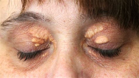 Maybe you would like to learn more about one of these? 4. Cholesterol Bump on Eyelid