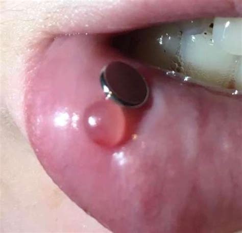 Guten abend, ich habe seit zwei tagen ein problem mit meiner unterlippe. Blase Unterlippe Innenseite? (Medizin, Entzündung, Lippe)