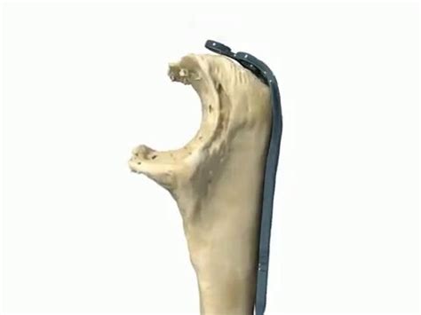 An olecranon fracture with anterior displacement of the radial history. olecranon fixation plate - YouTube