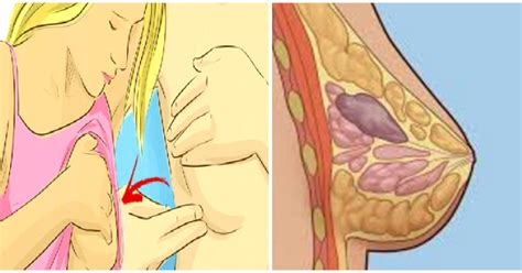 Kasus peradangan kanker payudara akan bervariasi, tetapi ada beberapa gejala umum. Ayo Bantu Sebarkan..!! Wanita Perlu di Catat! Benjolan ...