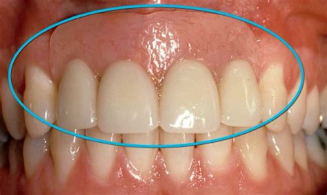 It may be fixed (i.e. Dr. Steve Chu, DDS's Smile Gallery | Removable Partial Denture