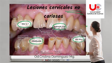 Las cervicales están entre la cabeza y la columna torácica. lesiones cervicales no cariosas by cristina dominguez