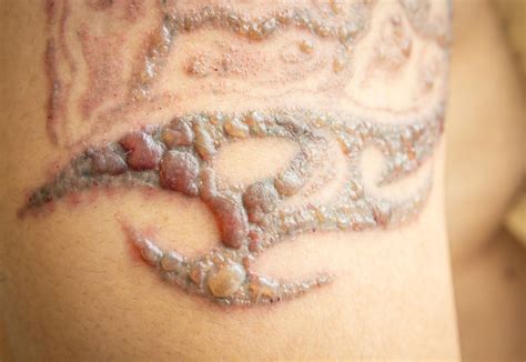 May 19, 2020 · tattoo blowouts are an unfortunate side effect for some people with new tattoos. Can Laser Tattoo Removal Cause Blistering? | MEDermis Laser Clinic