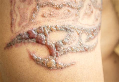 Most of the clinics request a fee of $10 for each pulse session. Can Laser Tattoo Removal Cause Blistering? | MEDermis ...