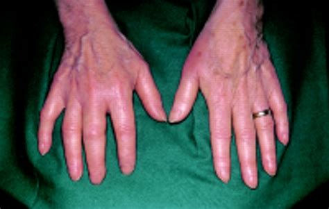 Maybe you would like to learn more about one of these? Reiter's syndrome following intravesical BCG immunotherapy ...