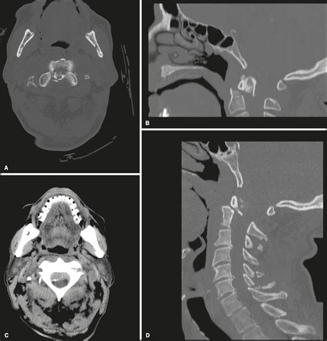 C1-C2 fractures in asymptomatic elderly patients with ...