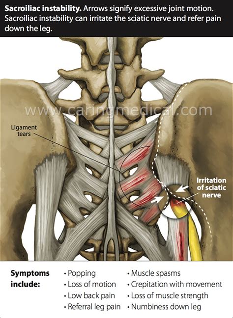 Having a solid core creates a foundation for all activities. Ligament laxity and spinal instability | Back pain ...