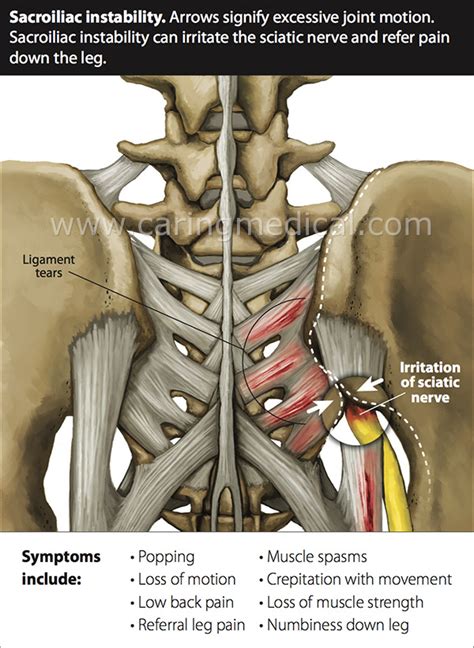 Thoracic ligaments connect bone to bone and keep multifidus muscle arches the back and minimally rotate it. Ligament laxity and spinal instability | Back pain ...