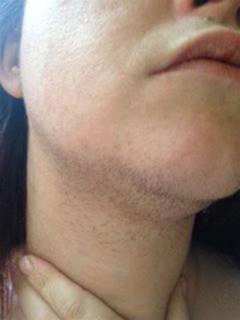 Facial hair with pcos we know that hirsutism is a symptom of high androgen or testosterone levels in women with pcos. How to stop facial hair growth due to pcos THAIPOLICEPLUS.COM