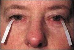 Sindrome di Sjogren