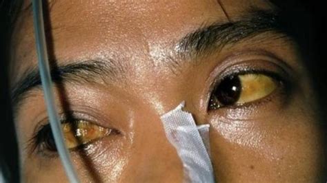 Katarak di usia muda disebut early onset cataract. Gadis Ini Meniggal Di Usia Muda Akibat "Kanser Hati ...