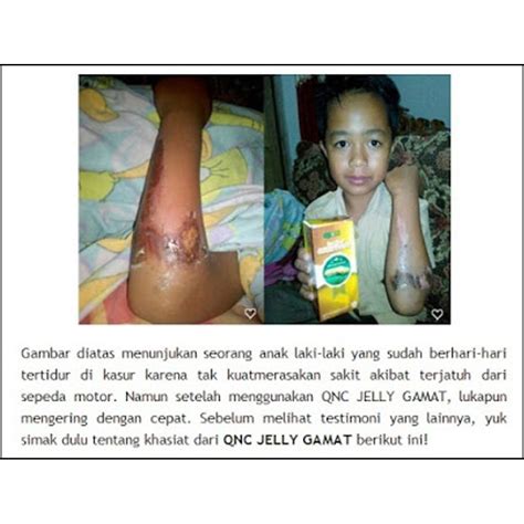 Contact minyak gamat on messenger. Obat alami untuk luka bakar // Qnc jelly gamat // With ...