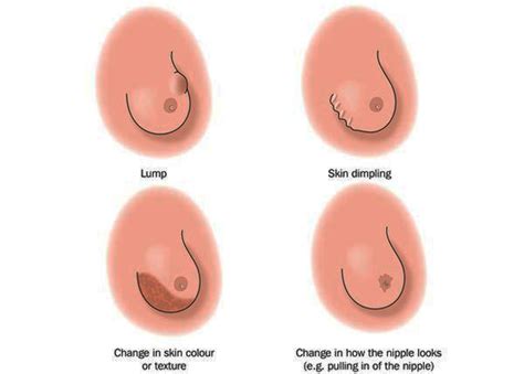 The lump could be sore or painless. !~!What is Breast Lumps? Get Information about Types of ...