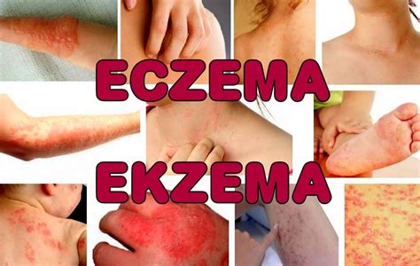 Forum discussions on eczema in malaysia eczema, any suggestion of good product? Ekzema-eczema | Eczema
